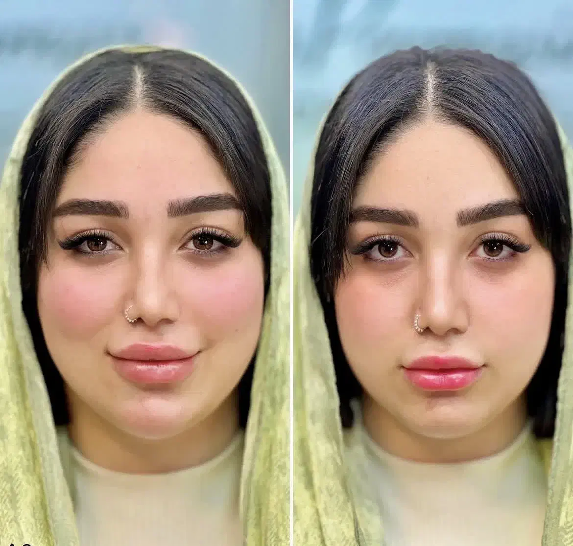 تخفیف ویژه.ژل بوتاکس با ترمیم رایگان فقط 750